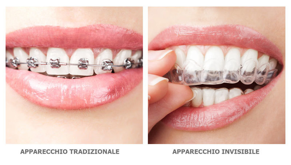 Ortodonzia mediante l’utilizzo di allineatori invisibili invisalign